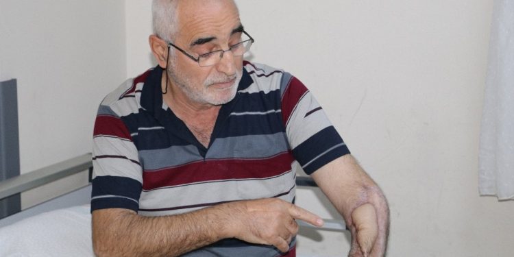 17 kez ameliyat oldu, çürüyen kolu doku nakli ile kurtuldu